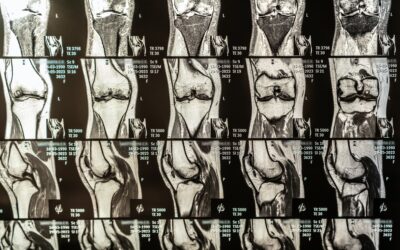 Mitos y realidades de la cirugía de reemplazo total de rodilla