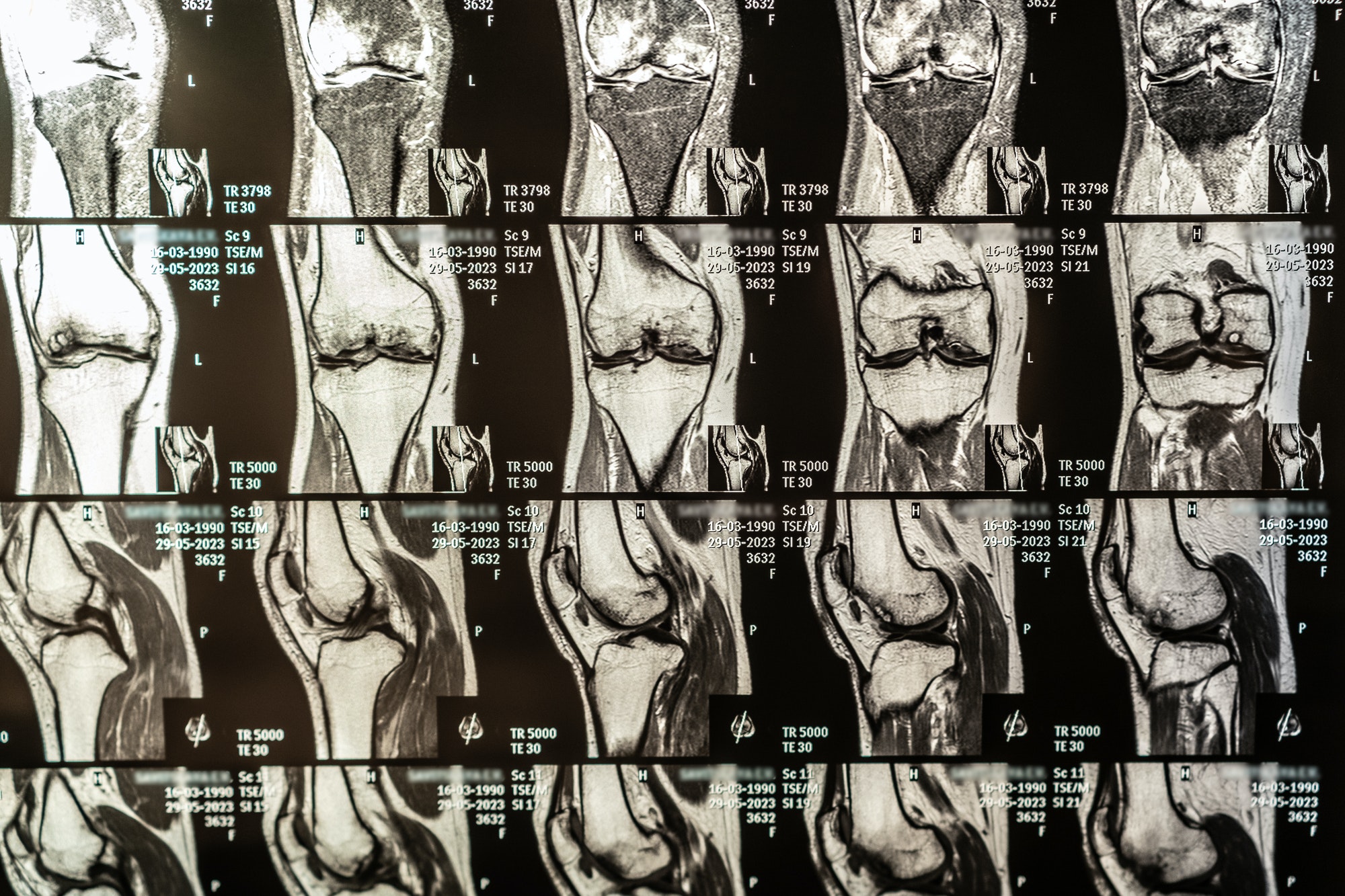 Magnetic resonance imaging of human knee joint for medical diagnosis